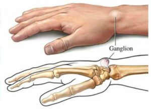 Ganglion – Mukoidna cista prsta