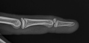 Mallet Finger - image malet-fragment-copy-300x146 on https://medentismanus.rs