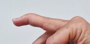 Mallet Finger - image maletprst-300x146 on https://medentismanus.rs