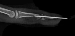 Mallet Finger - image malletigla-1-300x146 on https://medentismanus.rs